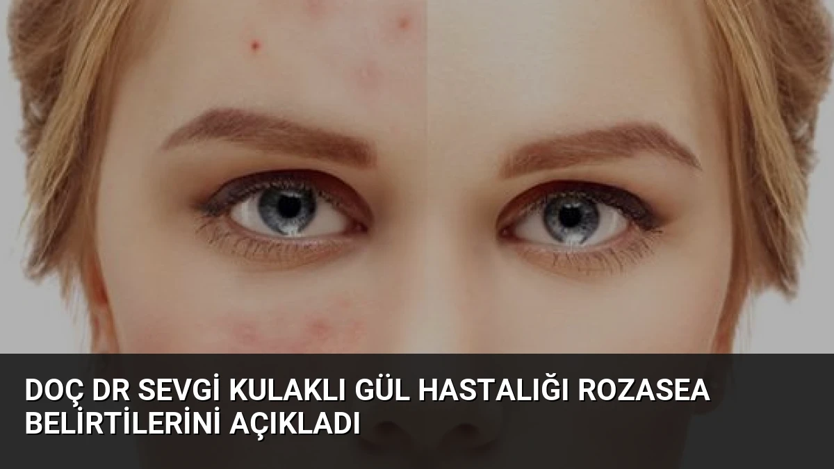 Doç Dr Sevgi Kulaklı Gül Hastalığı Rozasea Belirtilerini Açıkladı