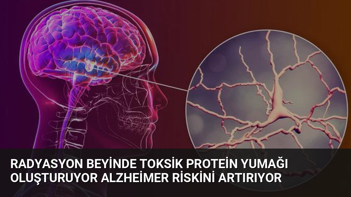 Radyasyon Beyinde Toksik Protein Yumağı Oluşturuyor Alzheimer Riskini Artırıyor